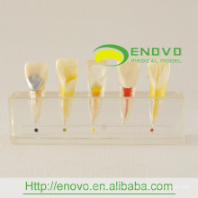 Modelo clínico de la enfermedad de pulpa dental del mejor precio EN-M6 del fabricante directamente